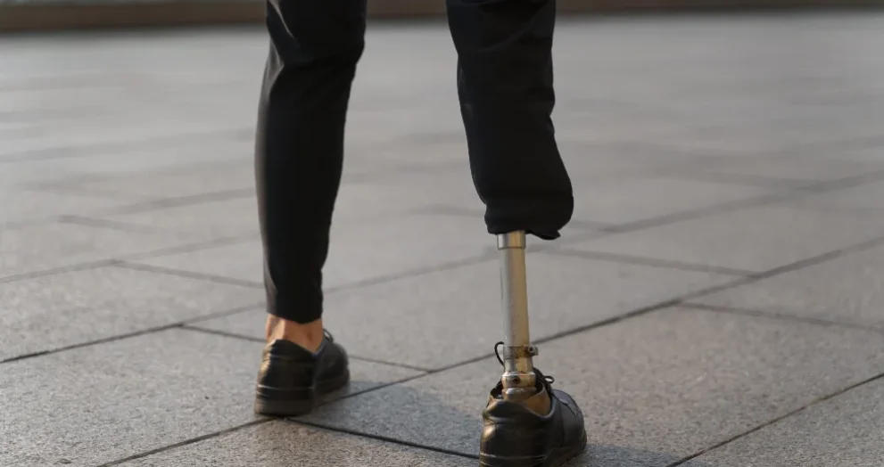 disabled person with amputee leg